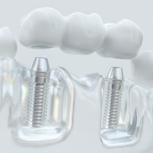 Example of dental implant dental bridge at Total Dental Solutions