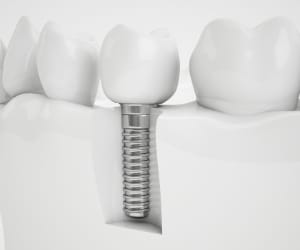 Animated mini dental implant replacement tooth